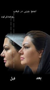 هایفو تراپی و رفع افتادگی چونه - بعد از درمان